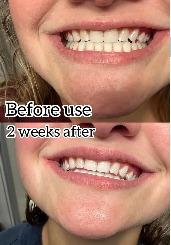 Colgate Optic Whitening Pen: Before & After