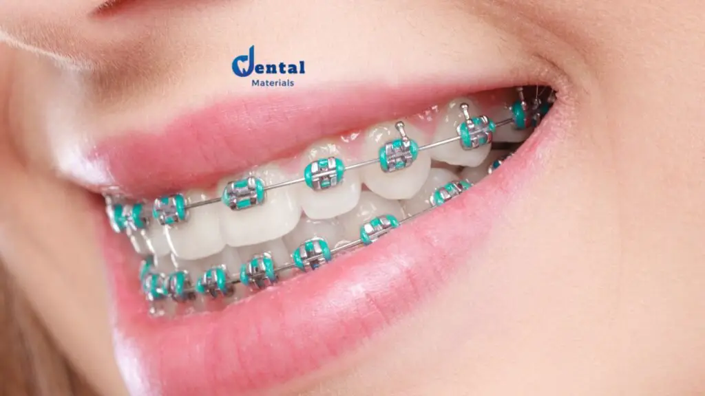 What to Expect When Getting Dental Braces
